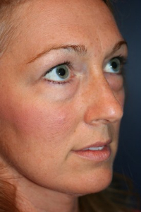 Facelift Patient 54175 Photo 3