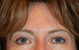Facial Fillers Patient 40810 Photo 4