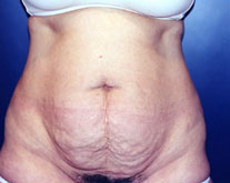 Tummy Tuck Patient 67379 Photo 1