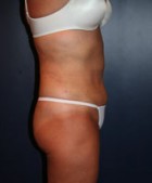 Liposculpture/Liposuction Patient 44612 Photo 2