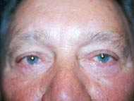 Eyelid Surgery Patient 71639 Photo 2