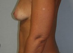 Breast Augmentation Patient 79158 Photo 1
