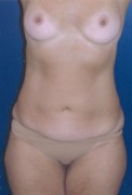 Breast Augmentation Patient 50635 Photo 1