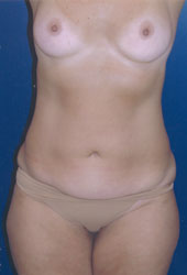 Breast Augmentation Patient 50635 Photo 1