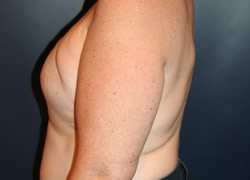 Breast Reconstruction Patient 13491 Photo 1