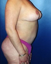 Liposculpture/Liposuction Patient 35366 Photo 4