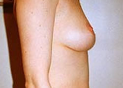 Breast Lift Patient 71861 Photo 1