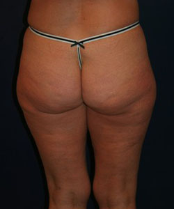 Saddle Bag Liposuction Patient 77601 Photo 1