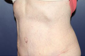 Tummy Tuck Patient 32584 Photo 4