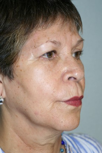 Facelift Patient 72436 Photo 3