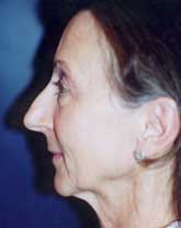 Rhinoplasty Patient 91506 Photo 3