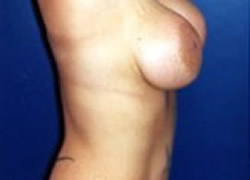 Breast Lift Patient 56914 Photo 3