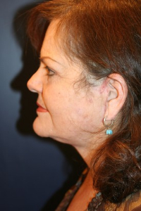 Facelift Patient 36734 Photo 2