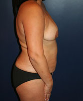 Tummy Tuck Patient 47655 Photo 1