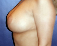 Breast Reduction Patient 96119 Photo 2
