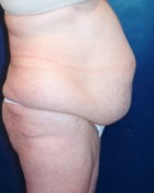 Tummy Tuck Patient 31720 Photo 1