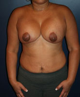 Tummy Tuck Patient 47655 Photo 4