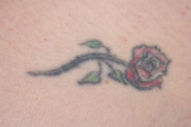 Tattoo Removal Patient 16111 Photo 1