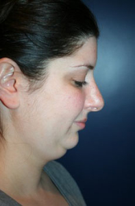 Chin Augmentation Patient 99366 Photo 3