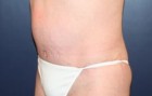 Tummy Tuck Patient 27475 Photo 2