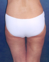 Tummy Tuck Patient 64354 Photo 6