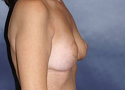 Breast Reduction Patient 93853 Photo 4