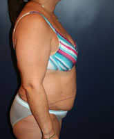 Tummy Tuck Patient 56322 Photo 3