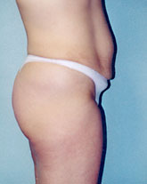 Tummy Tuck Patient 53162 Photo 3