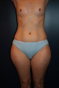 Breast Augmentation Patient 26539 Photo 1