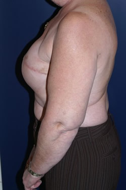 Breast Reconstruction Patient 50987 Photo 2