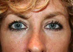 Brow Lift Patient 27228 Photo 1