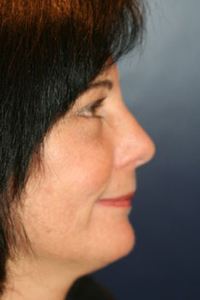 Rhinoplasty Patient 13404 Photo 4