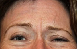 Facial Fillers Patient 40810 Photo 3