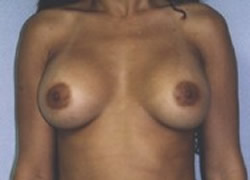 Breast Augmentation Patient 66933 Photo 2