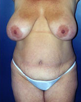 Breast Reduction Patient 27658 Photo 1