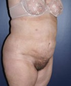 Liposculpture/Liposuction Patient 88624 Photo 2