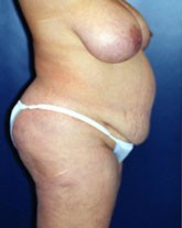 Liposculpture/Liposuction Patient 35366 Photo 3