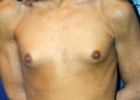 Breast Augmentation Patient 33756 Photo 1