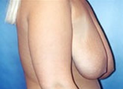 Breast Lift Patient 10997 Photo 3