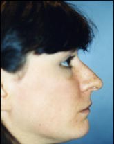 Rhinoplasty Patient 40133 Photo 3