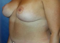 Breast Reduction Patient 50356 Photo 4