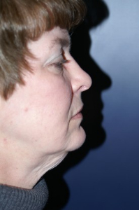 Facelift Patient 30275 Photo 1