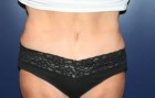 Tummy Tuck Patient 82205 Photo 2