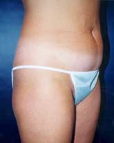 Liposculpture/Liposuction Patient 79741 Photo 3