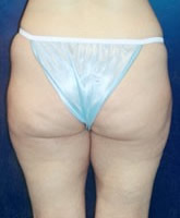 Liposculpture/Liposuction Patient 73931 Photo 3