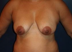Breast Lift Patient 52274 Photo 3