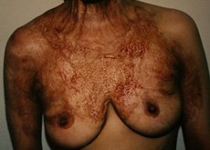 Breast Reconstruction Patient 76022 Photo 1