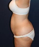 Tummy Tuck Patient 96601 Photo 1