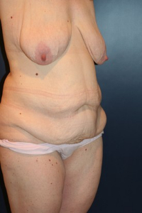 Massive Weight Loss Patient 79785 Photo 1