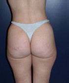 Liposculpture/Liposuction Patient 34471 Photo 1